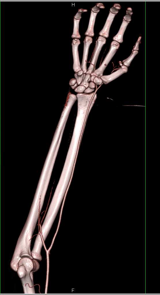 Laceration Hand with Active Bleed - CTisus CT Scan