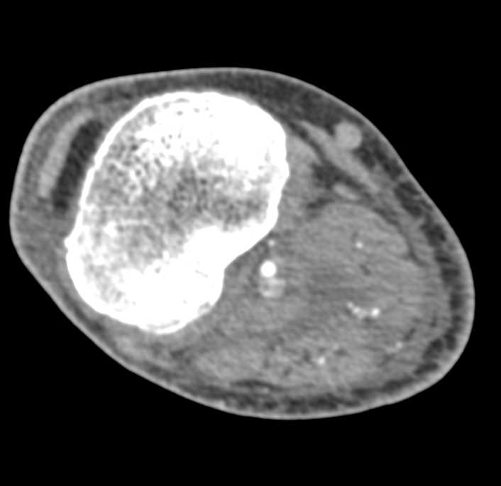 Active Bleed in Gastrocnemius Muscle - CTisus CT Scan