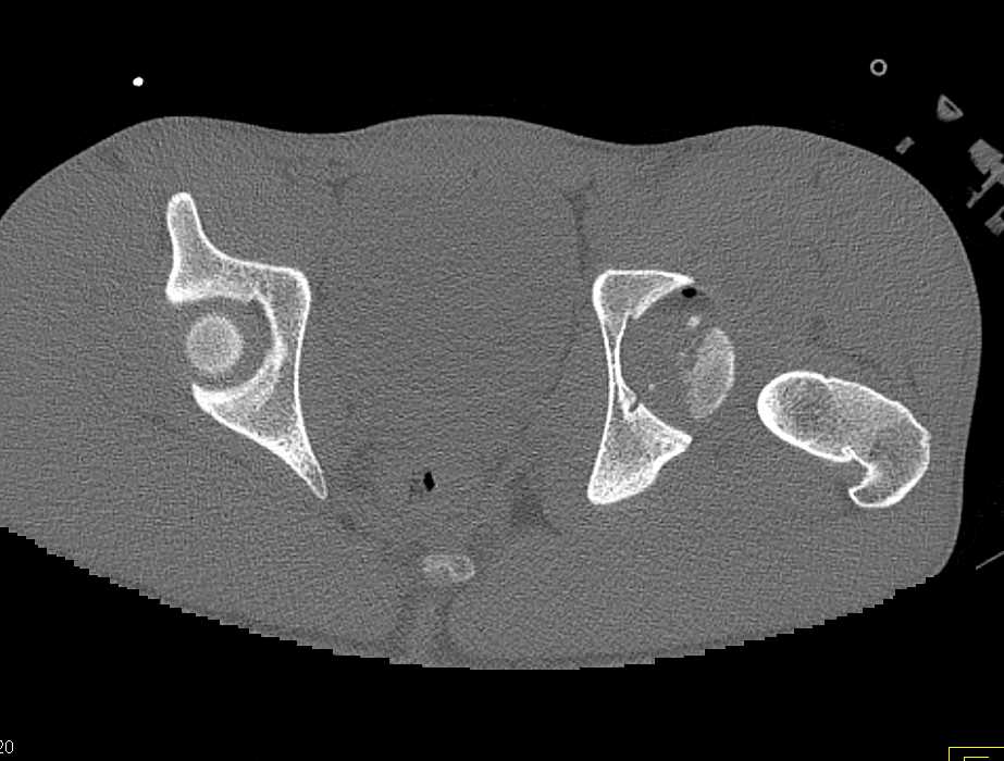 Left Hip Fracture with Dislocation - CTisus CT Scan