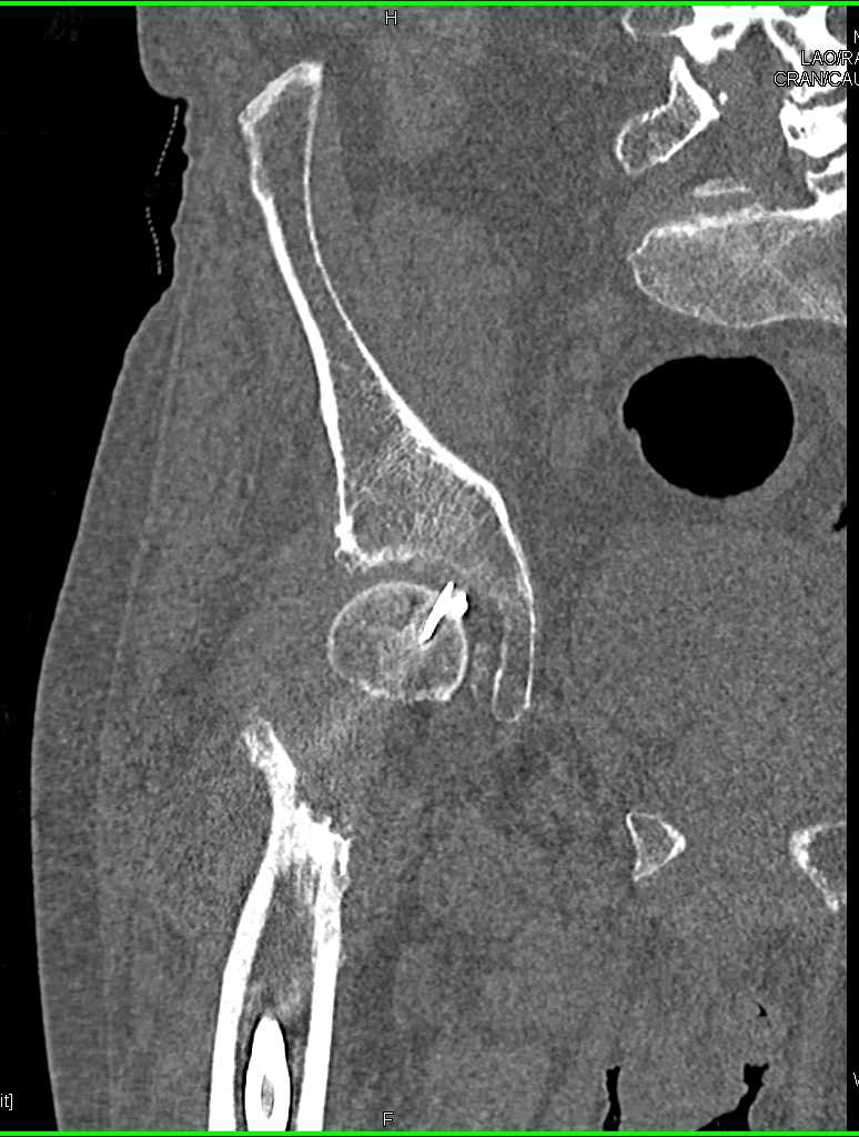 Pins Extend Through Right Femur - CTisus CT Scan