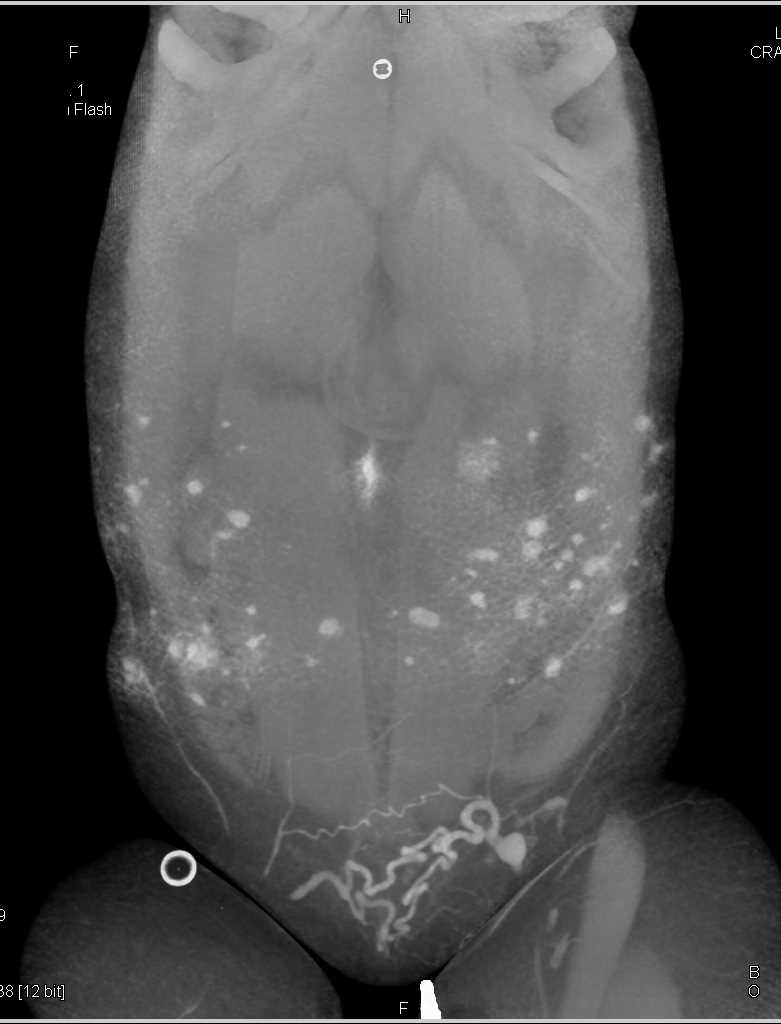 Multiple Subcutaneous Nodules in Lymphoma - CTisus CT Scan