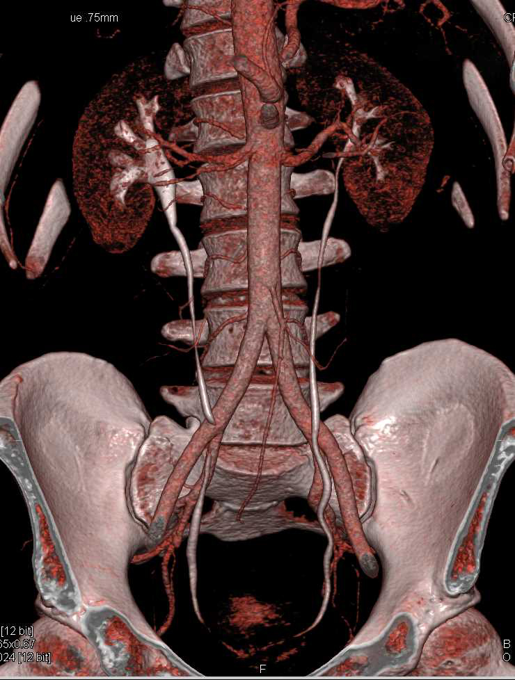 Liposarcoma Left Thigh - CTisus CT Scan