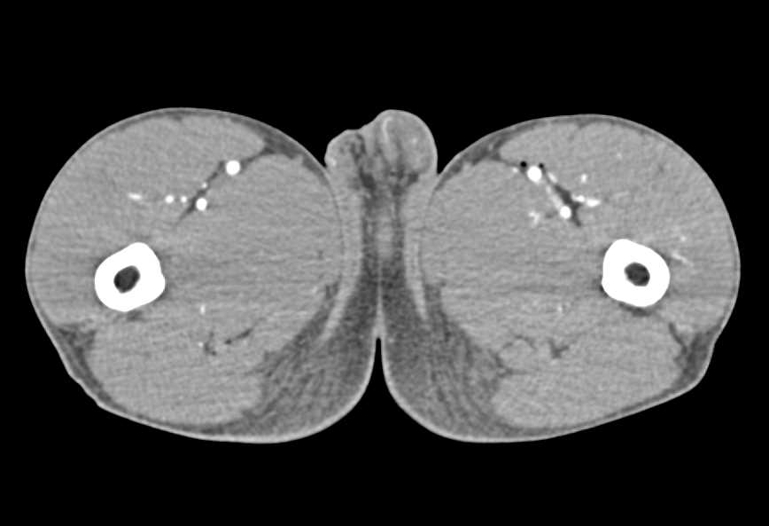 GSW Thigh with Early Venous Opacification - CTisus CT Scan