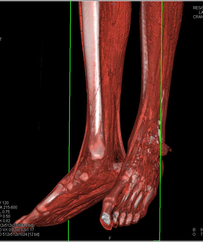 Open Wound Followed By Fixation and Antibiotic Beads - CTisus CT Scan