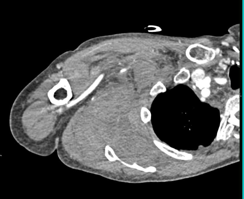 Hematoma Chest Wall Near Axilla with Active Bleeding - CTisus CT Scan
