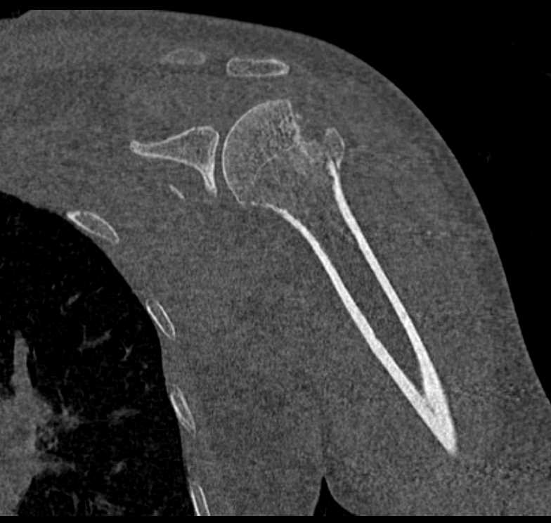 Fracture Dislocation of the Shoulder with Glenoid Fracture and Reduction - CTisus CT Scan