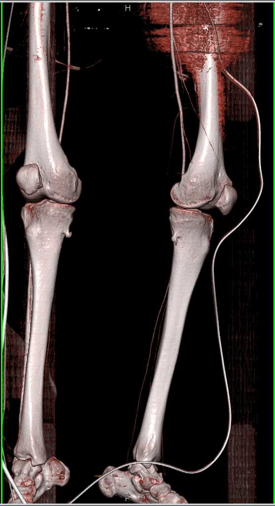 Vascular Mapping with Artifact off Hardware - CTisus CT Scan