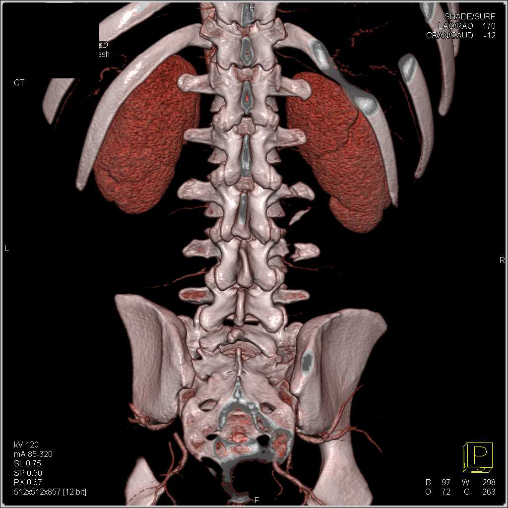 3D Imaging of the Lumbar Spine - CTisus CT Scan
