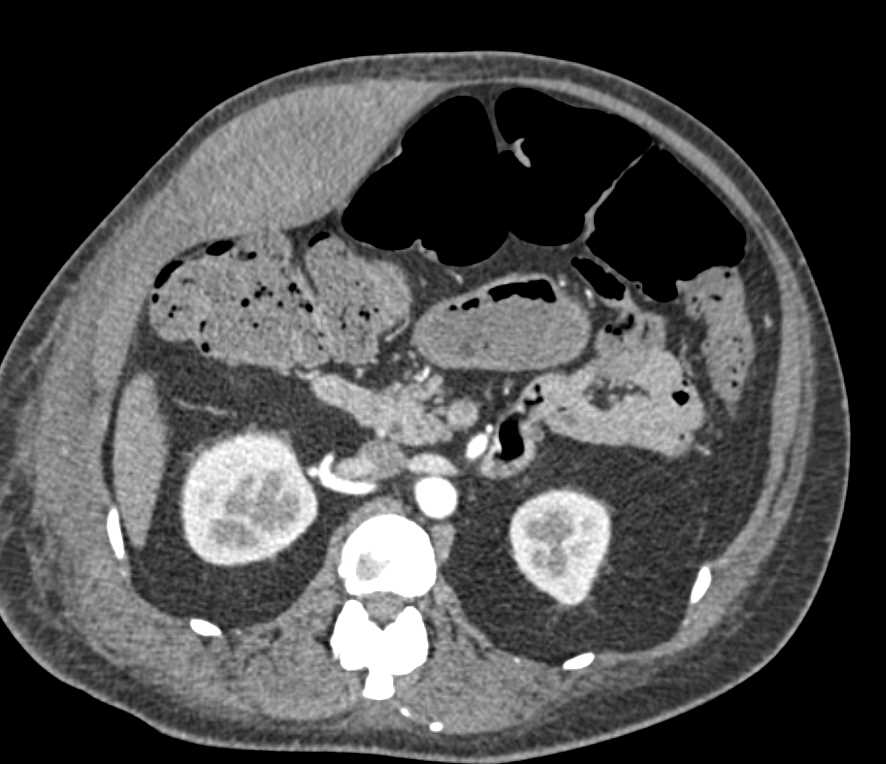 Right Rectus Sheth Hematoma - CTisus CT Scan