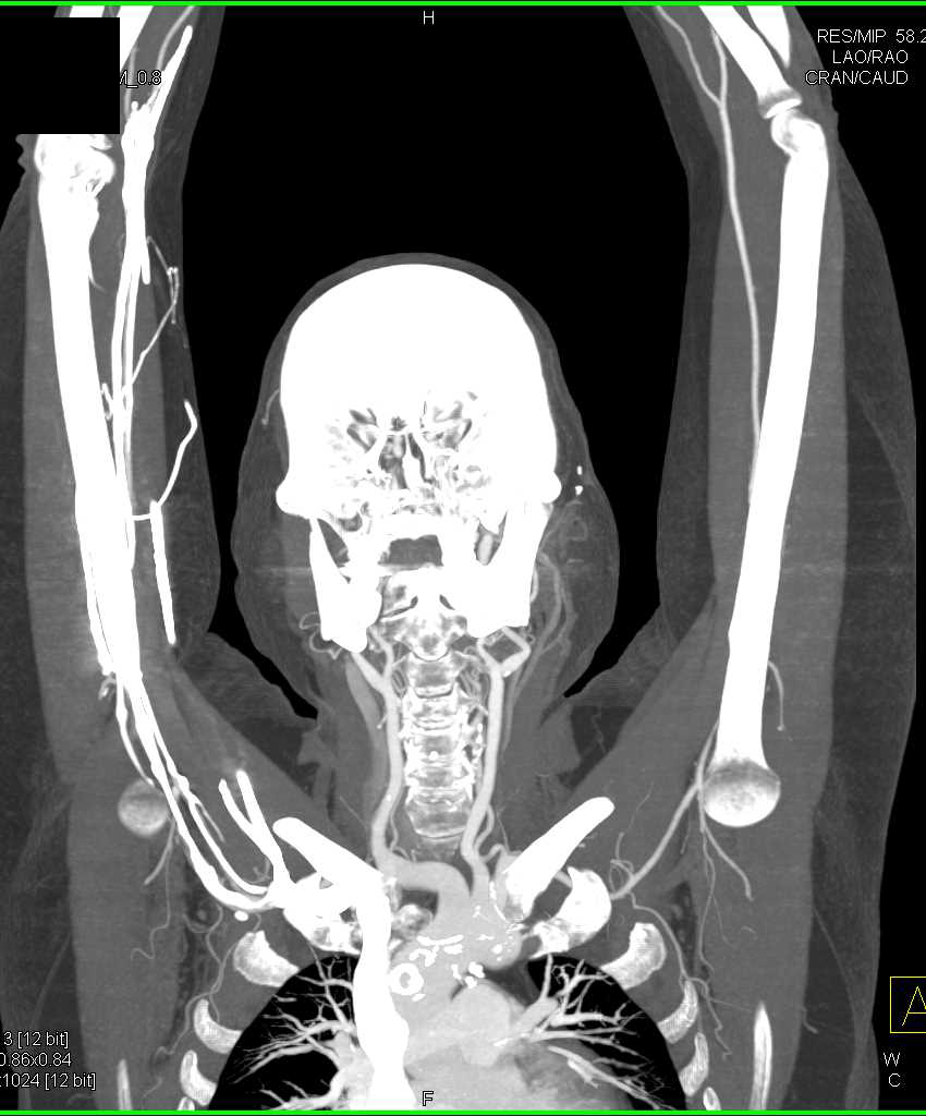 Vascular Mapping for Hand Transplant Surgery - CTisus CT Scan