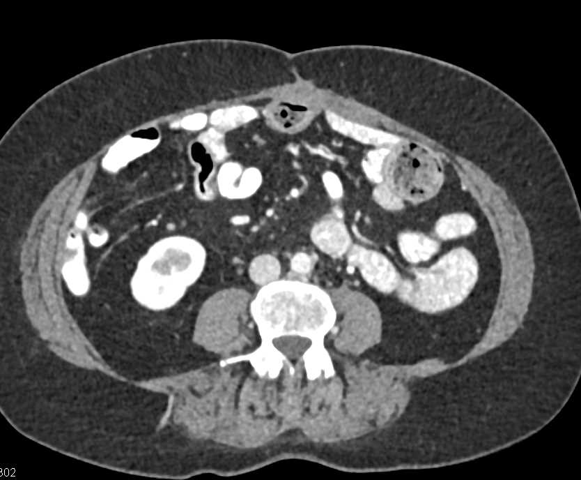 Desmoid Tumor in the Abdominal Wall - CTisus CT Scan