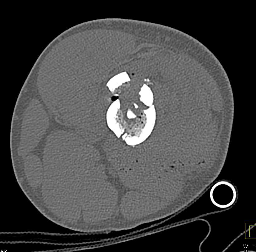 GSW with Femur Fracture - CTisus CT Scan