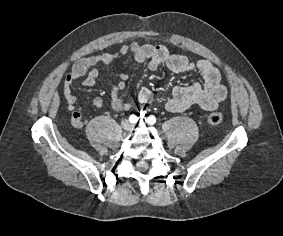 Hardware From Spinal Surgery Abuts Aorta - CTisus CT Scan