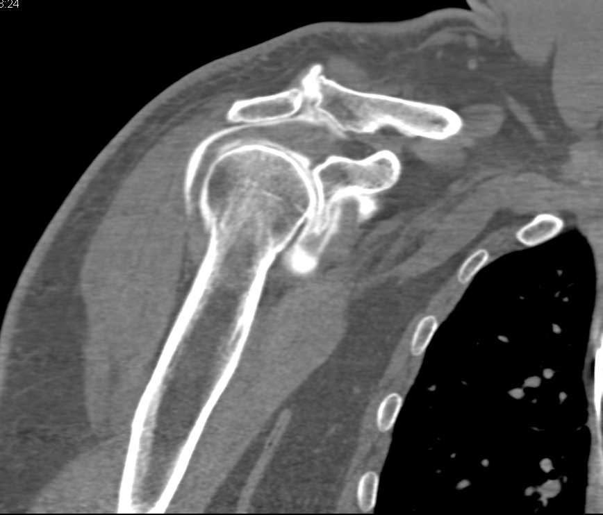 Shoulder Arthrogram with Rotator Cuff Tear - CTisus CT Scan