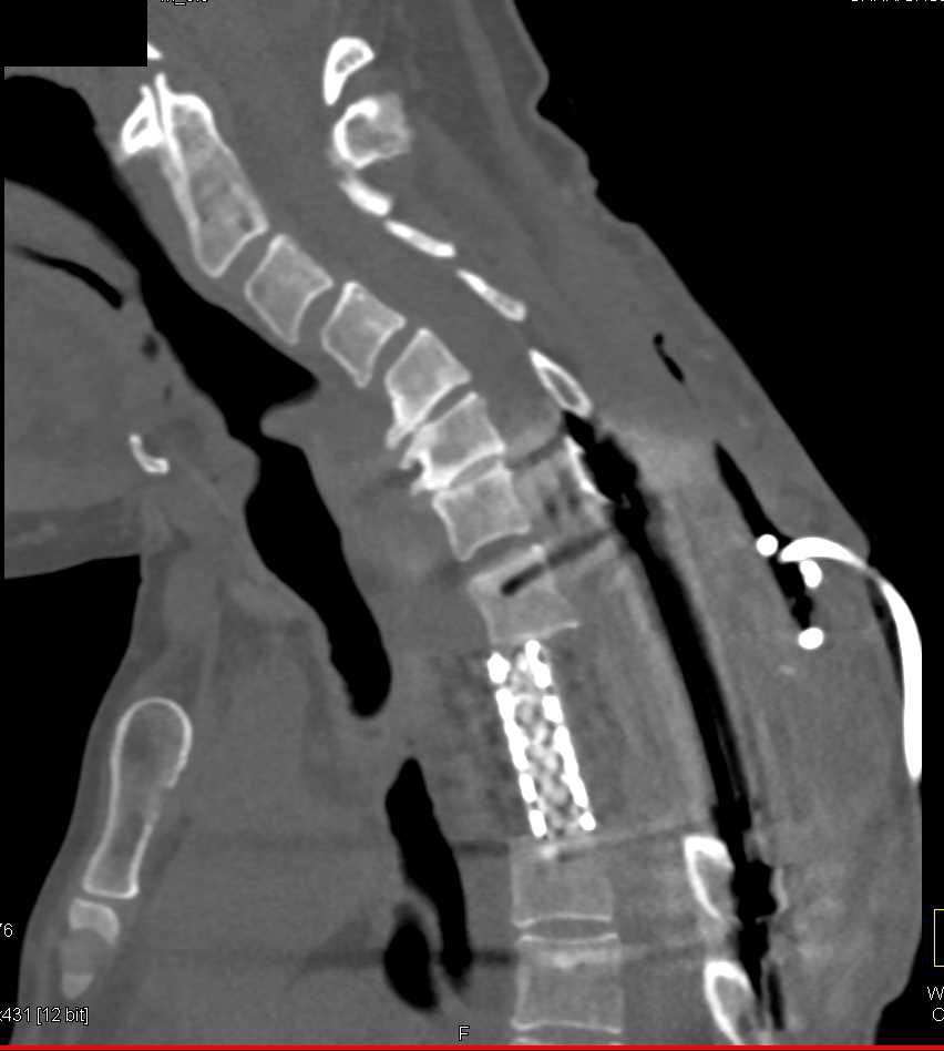 Surgical Repair with Implant T-Spine - CTisus CT Scan