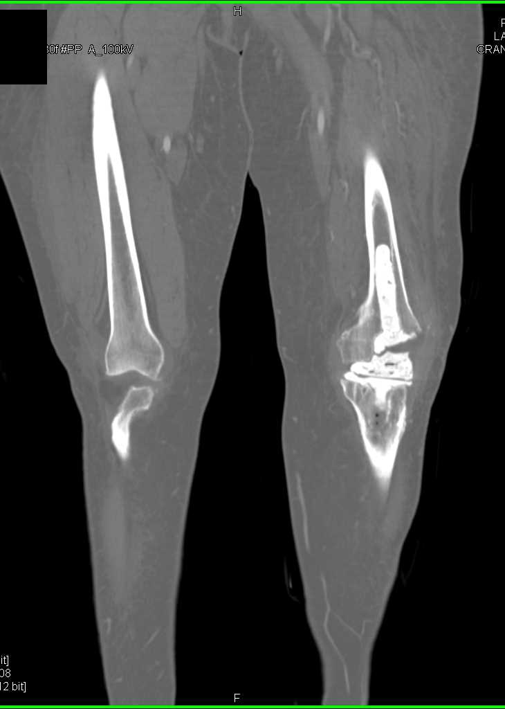 Vascular Map in Patient with Knee Replacement - CTisus CT Scan