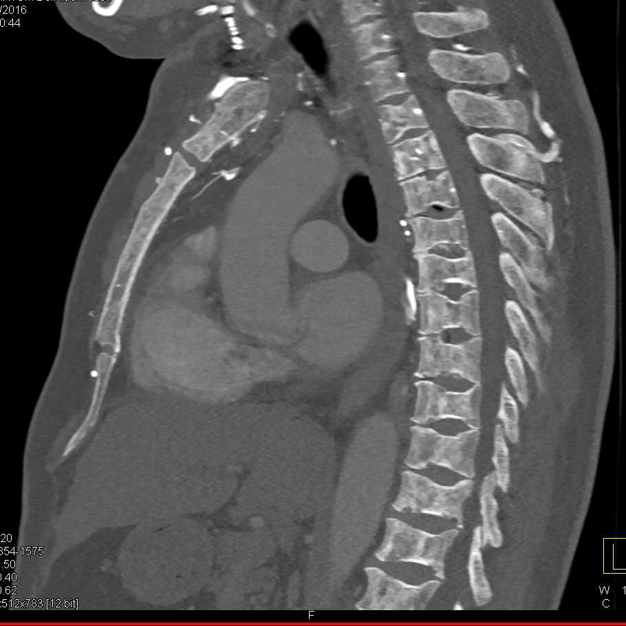 Metastatic Prostate Cancer to Bone - CTisus CT Scan