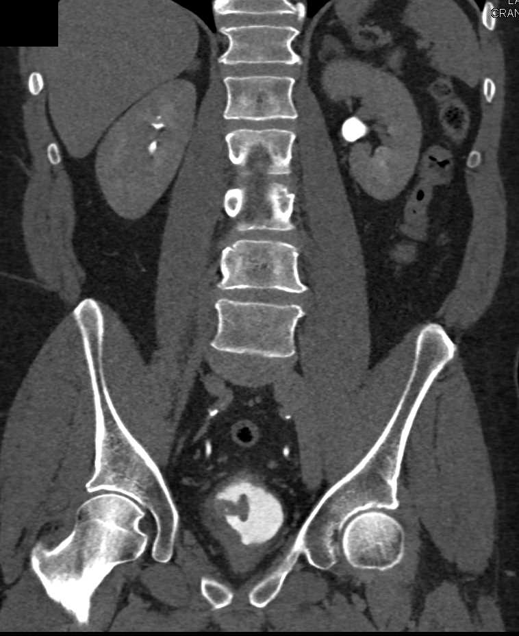 Bladder Cancer with Blastic Bone Metastases - CTisus CT Scan