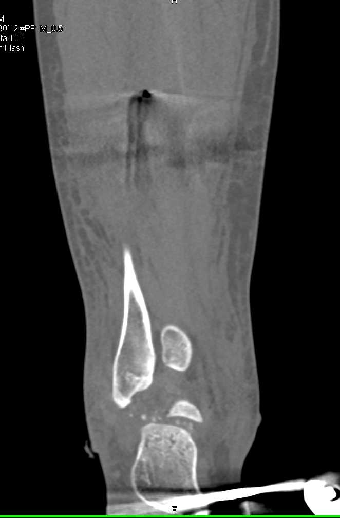Talus Fracture Dislocation with Repair - CTisus CT Scan