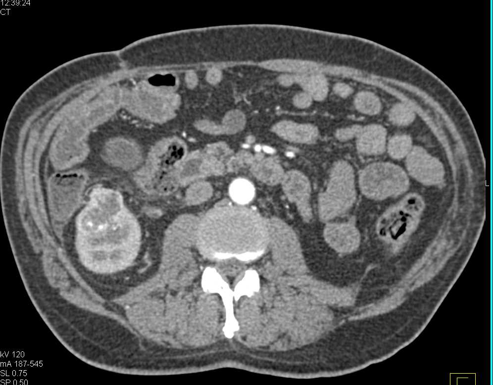 Metastatic Renal Cell Carcinoma to the Left Iliopsoas Muscle and Contralateral Kidney - CTisus CT Scan