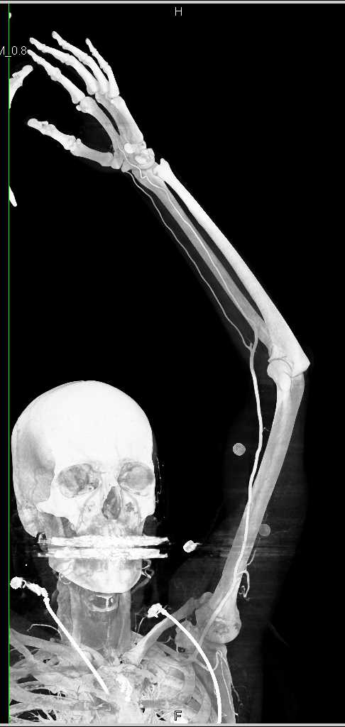 CTA Upper Extremity with Bone Removal - CTisus CT Scan