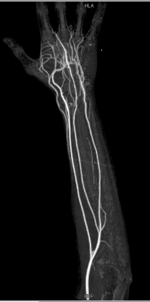 Subcutaneous Abscess Hand With CTA - CTisus CT Scan