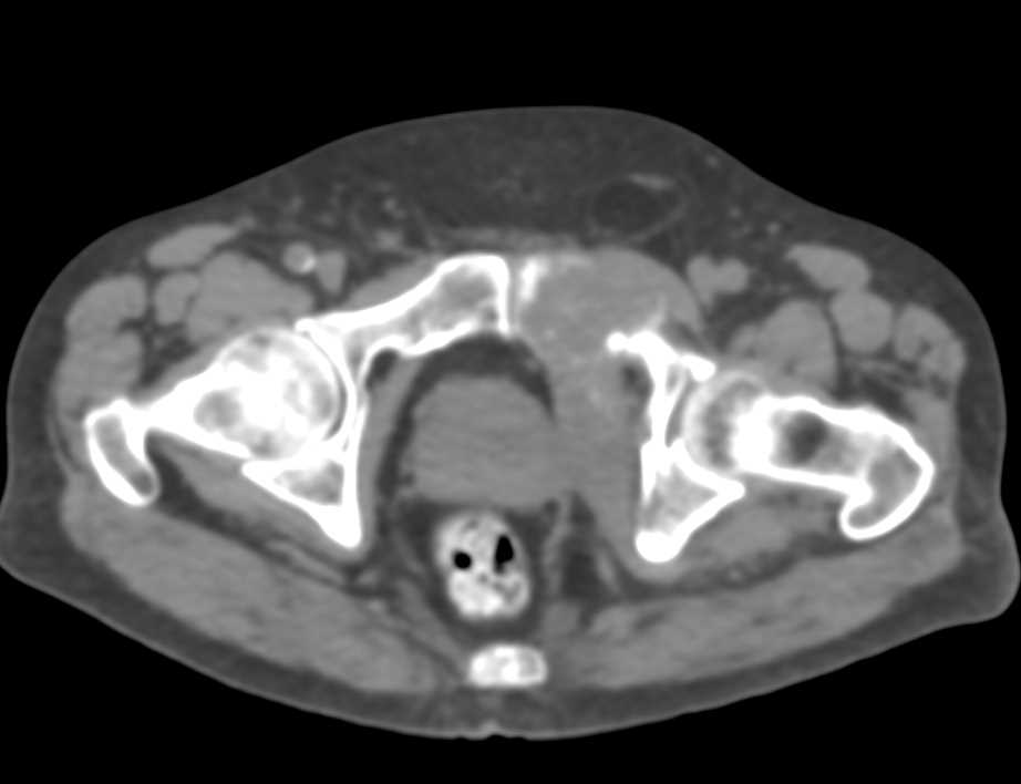 Lung Cancer Metastatic to the Pelvis - CTisus CT Scan