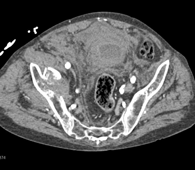 Complex Right Acetabular Fracture with Pelvic Bleed - CTisus CT Scan