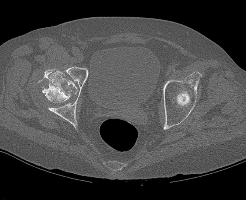 Avascular Necrosis (AVN) with Subchondral Collapse Right Femoral Head - CTisus CT Scan
