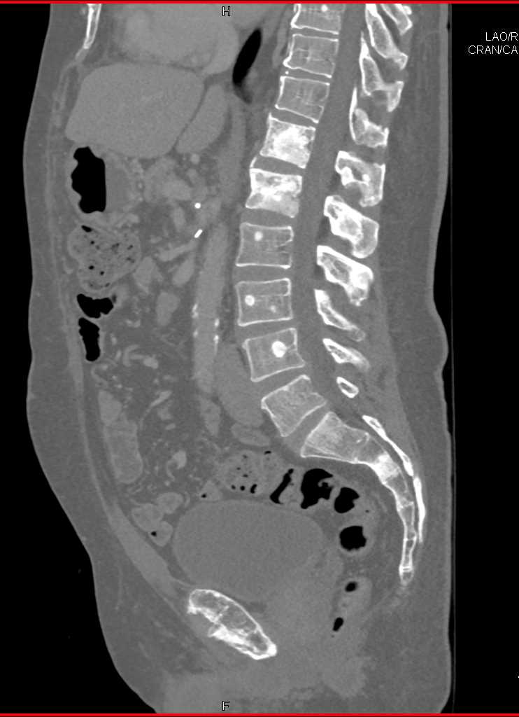 Blastic Bone Metastases from Prostate Cancer - CTisus CT Scan