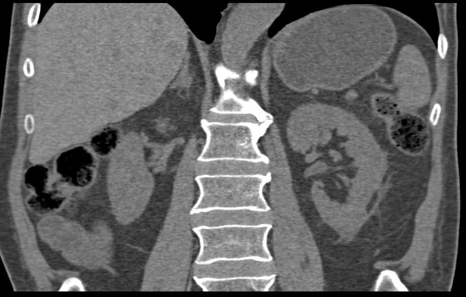 Renal Cell Carcinoma with Bone Metastases - CTisus CT Scan