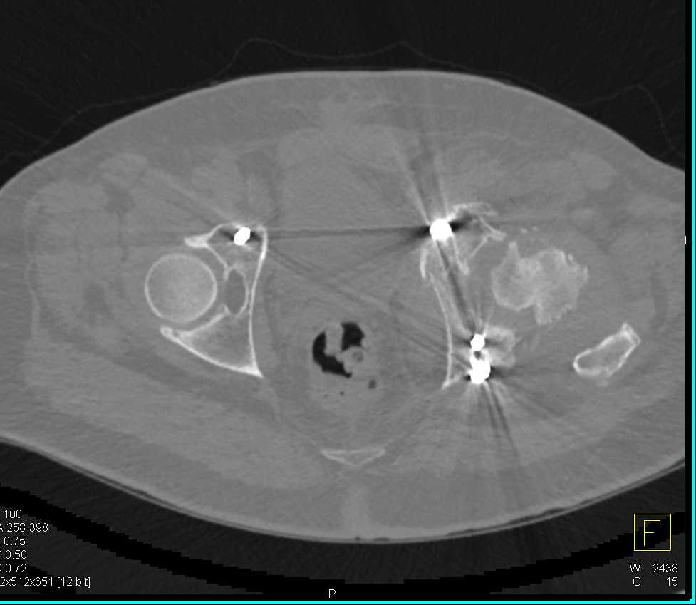 Heterotopic Ossification Left Hip due to Prior Trauma - CTisus CT Scan