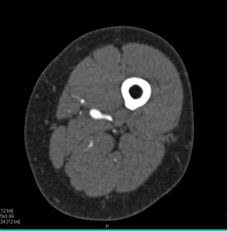 Trauma and Patellar Fracture - CTisus CT Scan