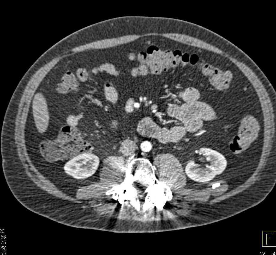 Atrophy Left Thigh and Calf Musculature - CTisus CT Scan