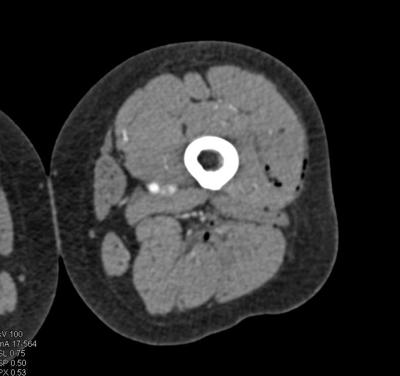 Gunshot Wound (GSW) Thigh Without Vascular Injury - CTisus CT Scan