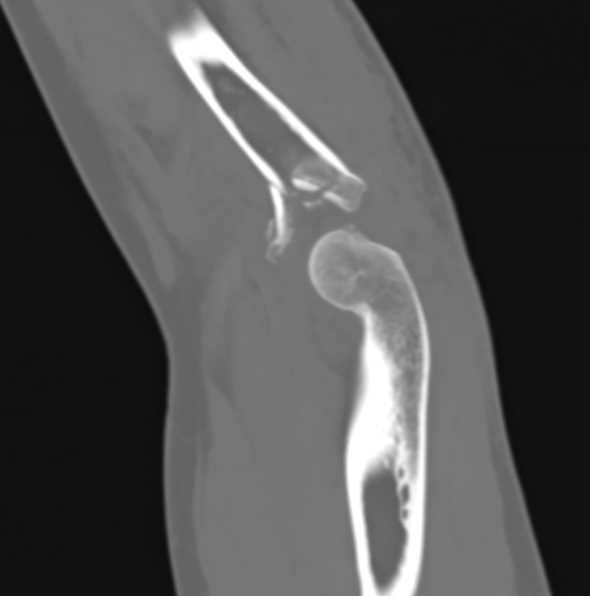 Positive Fat Pad with Radial Head Fracture - CTisus CT Scan