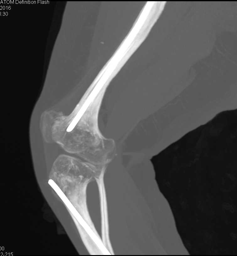 Osteogenesis Imperfecta - CTisus CT Scan