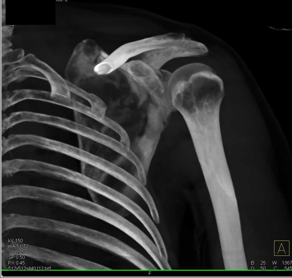 Scapular Fracture - CTisus CT Scan