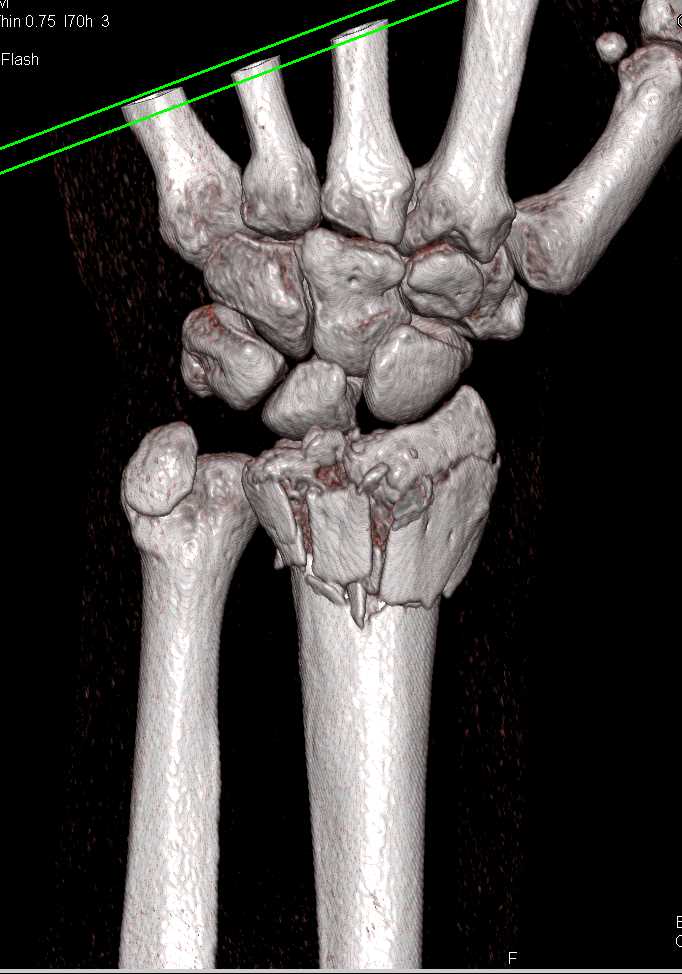 Distal Radius and Ulnar Fractures - CTisus CT Scan
