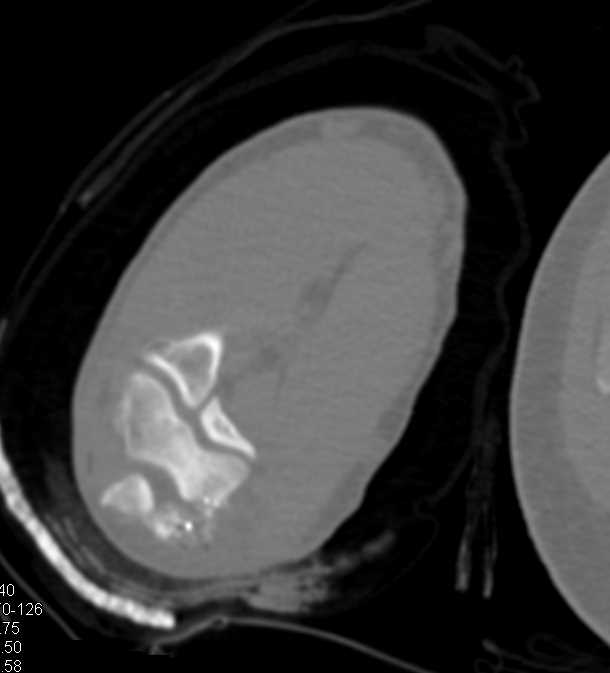 Gunshot Wound (GSW) with Fracture and Dislocation at the Elbow - CTisus CT Scan