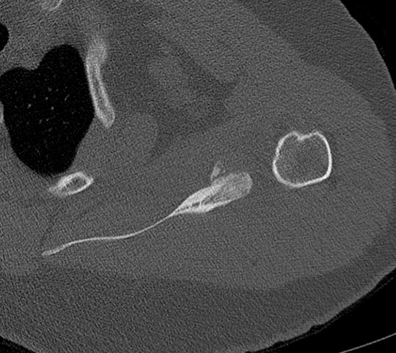 Sequelae of Fracture Dislocation of the Shoulder - CTisus CT Scan
