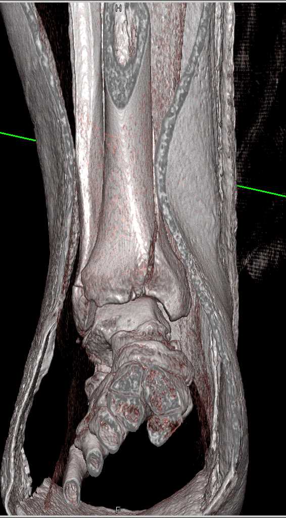 Distal Tibia and Fibular Fractures - CTisus CT Scan