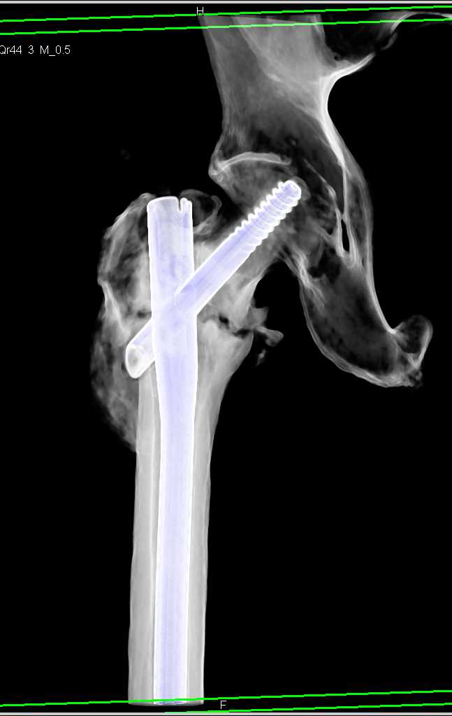 Healing Femoral Neck Fracture - CTisus CT Scan