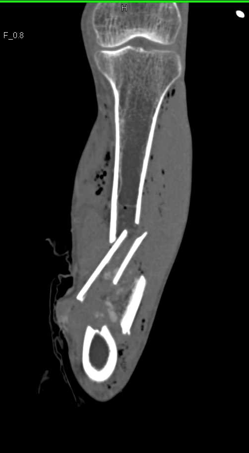 Comminuted Tibial Fracture with Vascular Injury - CTisus CT Scan
