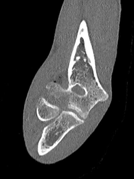 Distal Humerus Fracture - CTisus CT Scan