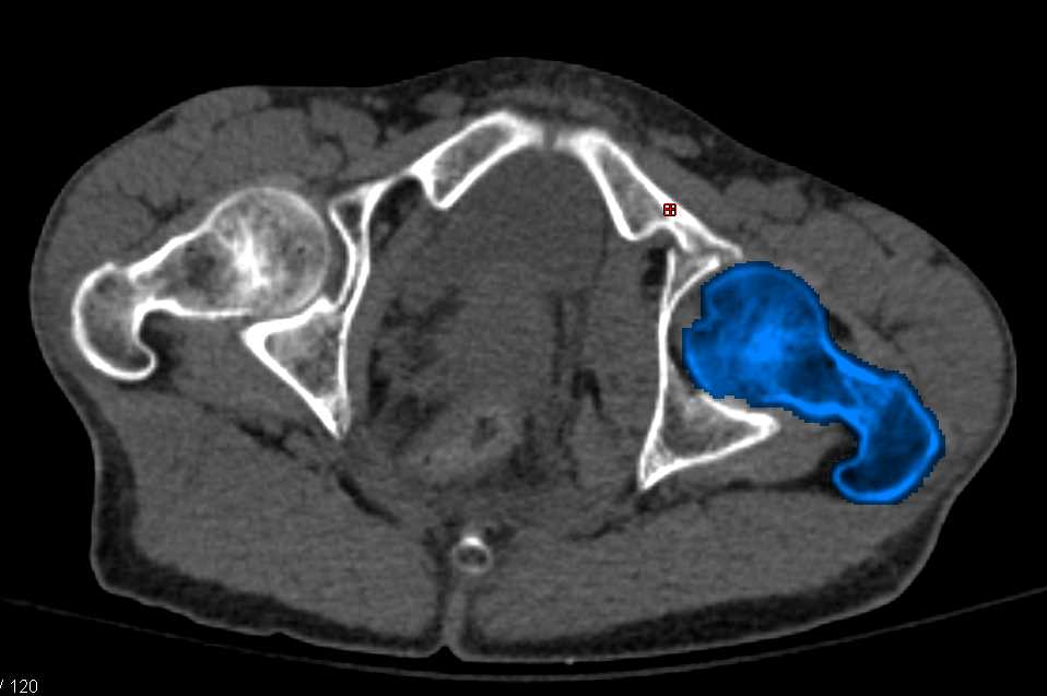 Acetabular Fracture with Automated Bone Removal - CTisus CT Scan