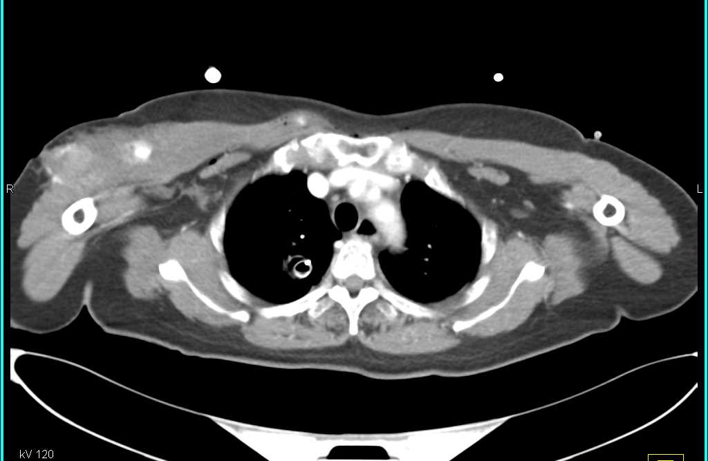 Gunshot Wound (GSW) to Right Pectoralis Muscle and to Thigh - CTisus CT Scan