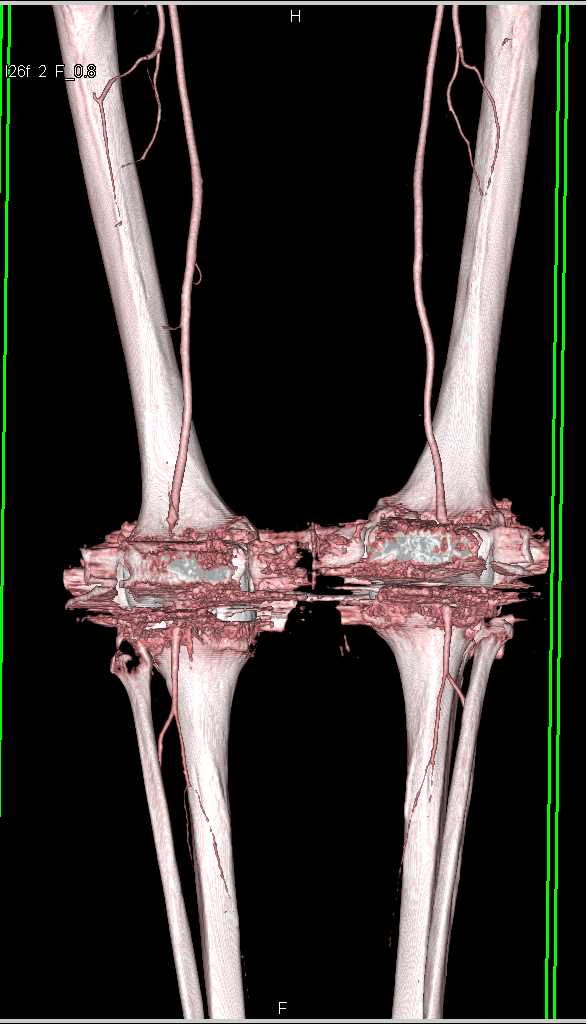 Artifact from Bilateral Total Knee Replacement (TKR) - CTisus CT Scan