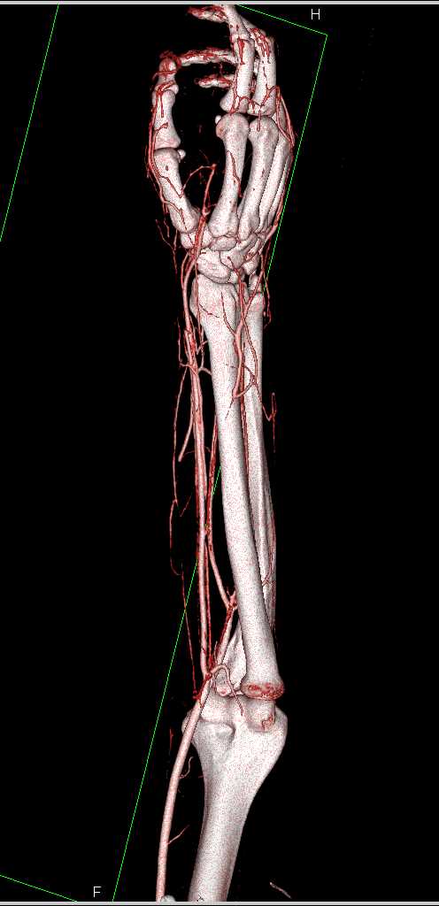 Soft Tissue Injury to the Wrist - CTisus CT Scan