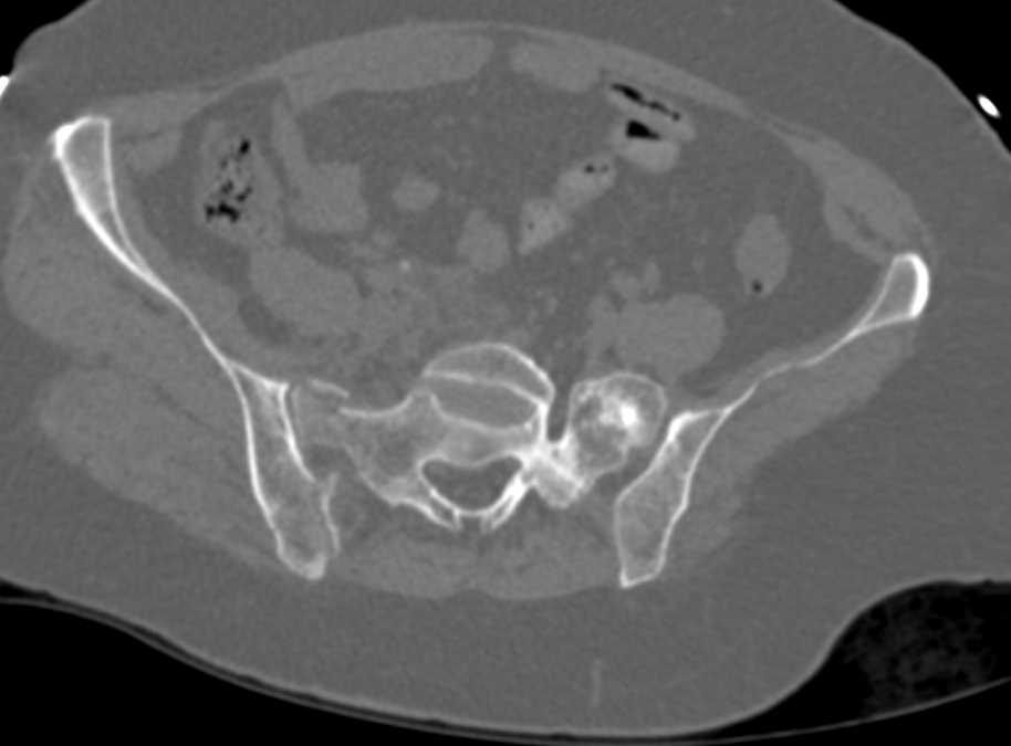 Sacral and Pelvic Fractures - CTisus CT Scan